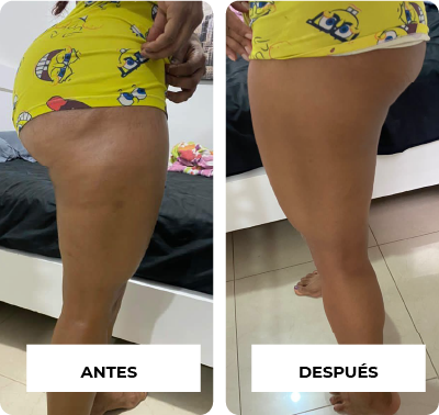 BYE BYE CELULITIS™: ¡Dile Adiós a la Celulitis de MANERA 100% NATURAL!