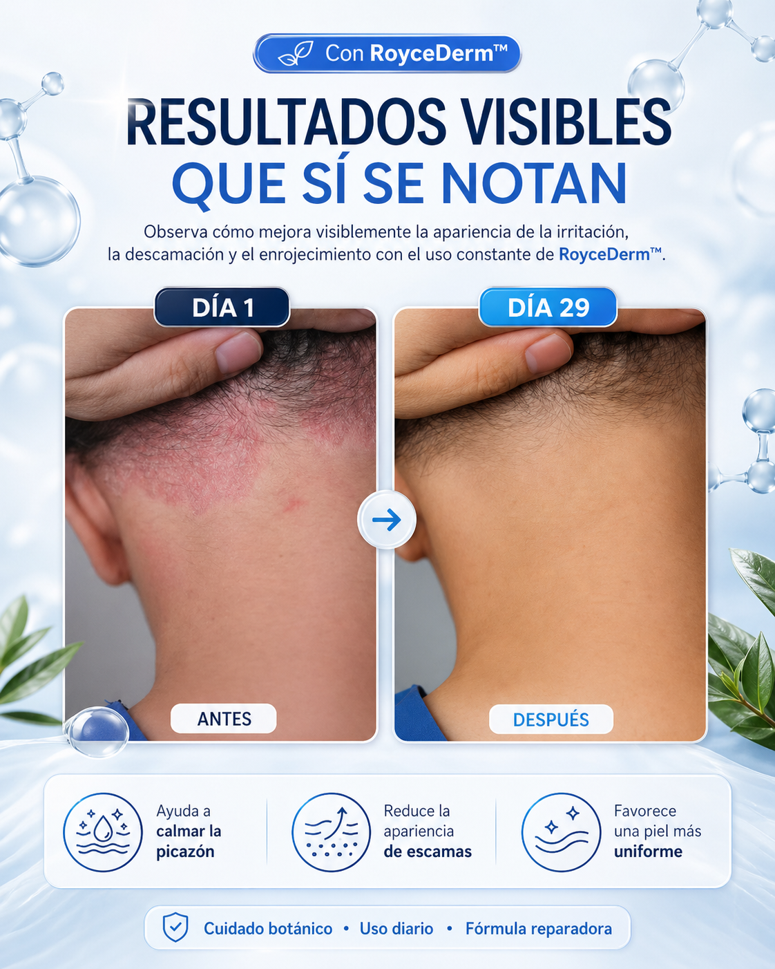 ROYCEDERM™️: DESASTE DE LA CASPA,DERMATITIS Y PSORIASIS