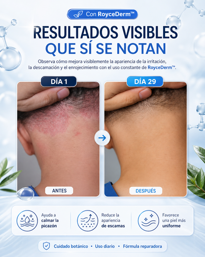 ROYCEDERM™️: DESASTE DE LA CASPA,DERMATITIS Y PSORIASIS